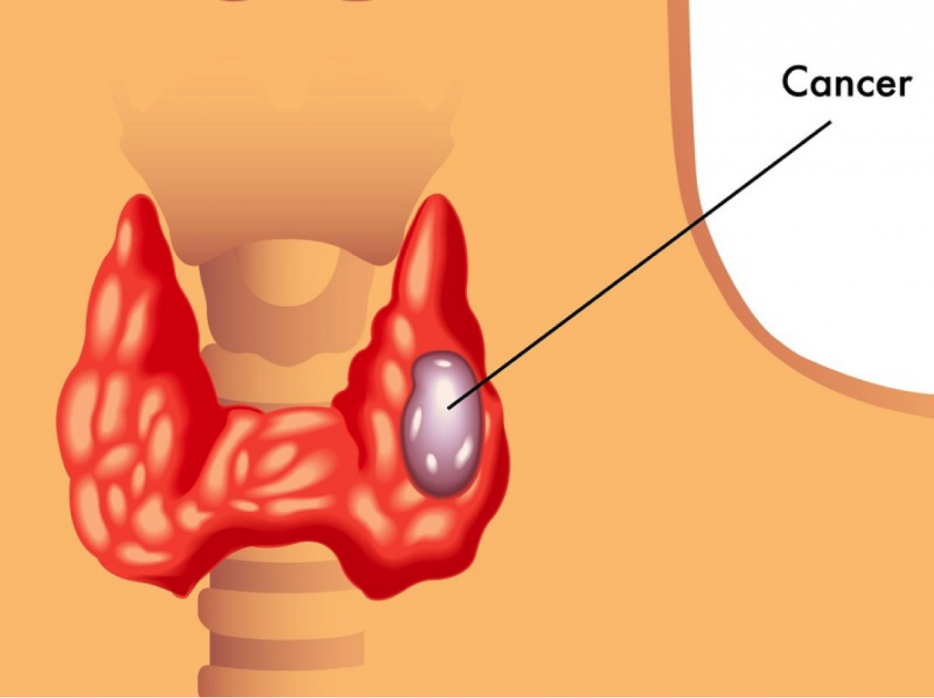 Is Thyroid Cancer Related To Lung Cancer